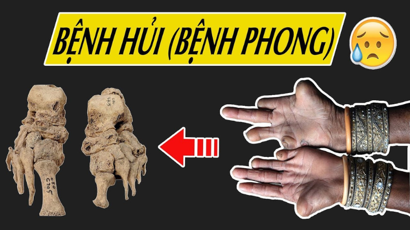 bệnh phong hủi là gì