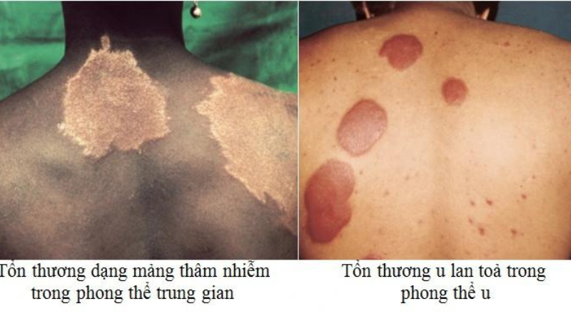 3 triệu chứng thường gặp bệnh phong