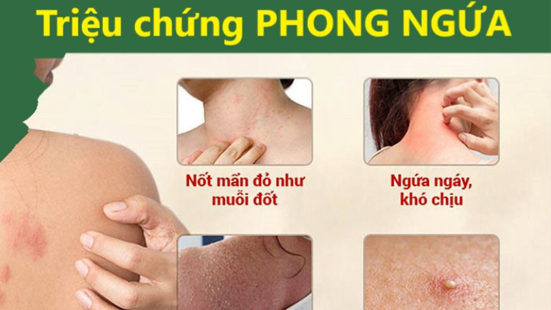 3 triệu chứng thường gặp bệnh phong