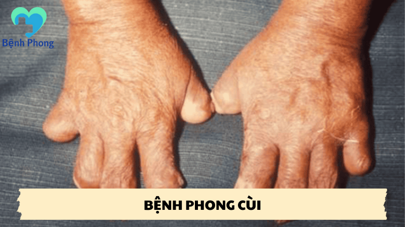 bệnh phong cùi