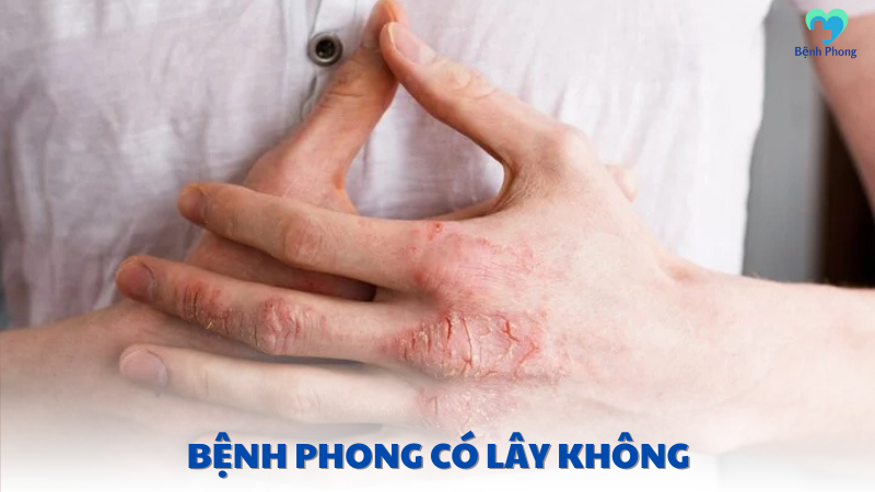 bệnh phong có lây không